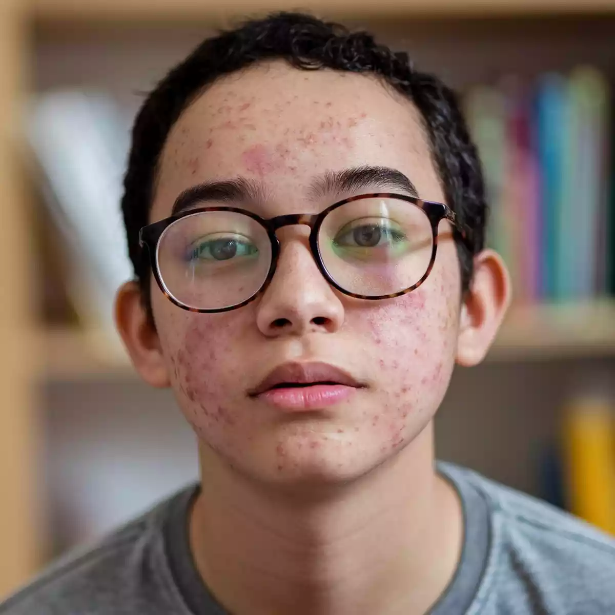 Η εφαρμογή του ACNE HERMAL γίνεται τοπικά στις προσβεβλημένες περιοχές του δέρματος, συνήθως δύο φορές την ημέρα.