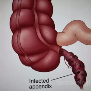 Σκωληκοειδίτιδα συμπτώματα- Σχηματική αναπαράσταση