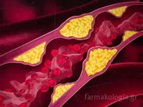 Απεικόνιση αθηρωματικής πλάκας που δημιουργεί η χοληστερίνη στα τοιχώματα των αρτηριών.