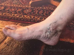 Ασθενής με εμφανές οίδημα και ερυθρότητα που υποδηλώνει θρόμβο στο πόδι κατά την κλινική εξέταση.