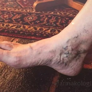 Ασθενής με εμφανές οίδημα και ερυθρότητα που υποδηλώνει θρόμβο στο πόδι κατά την κλινική εξέταση.