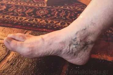 Ασθενής με εμφανές οίδημα και ερυθρότητα που υποδηλώνει θρόμβο στο πόδι κατά την κλινική εξέταση.