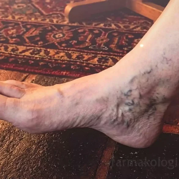 Ασθενής με εμφανές οίδημα και ερυθρότητα που υποδηλώνει θρόμβο στο πόδι κατά την κλινική εξέταση.