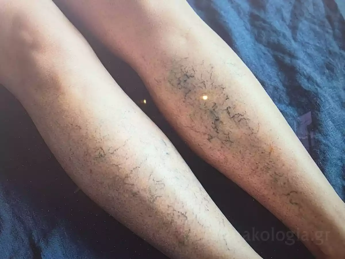 Εικόνα που δείχνει τη ροή του αίματος και το σημείο που έχει σχηματιστεί θρόμβος στο πόδι.